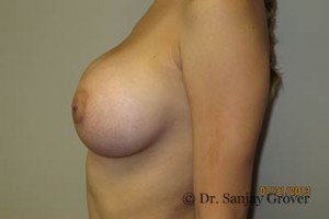 Breast Augmentation Before and After 281 | Grover Aesthetics
