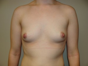 Breast Augmentation Before and After | Grover Aesthetics