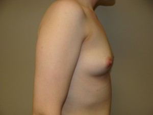 Breast Augmentation Before and After 282 | Grover Aesthetics