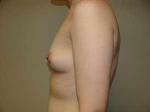 Breast Augmentation Before and After 282 | Grover Aesthetics
