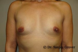 Breast Augmentation Before and After 99 | Sanjay Grover MD FACS