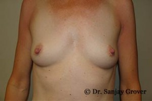 Breast Augmentation Before and After 254 | Sanjay Grover MD FACS