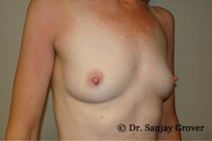 Breast Augmentation Before and After 284 | Sanjay Grover MD FACS