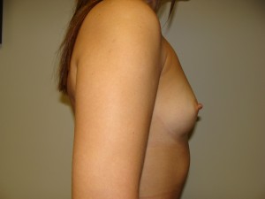 Breast Augmentation Before and After 284 | Sanjay Grover MD FACS