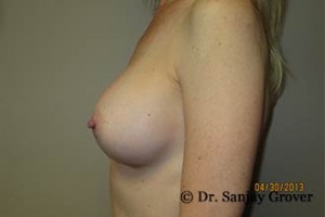 Breast Augmentation Before and After 284 | Sanjay Grover MD FACS