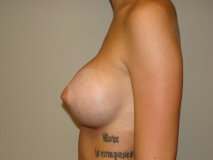 Breast Augmentation Before and After 286 | Grover Aesthetics