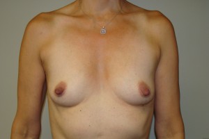 Breast Augmentation Before and After | Grover Aesthetics