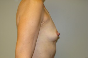 Breast Augmentation Before and After 287 | Grover Aesthetics