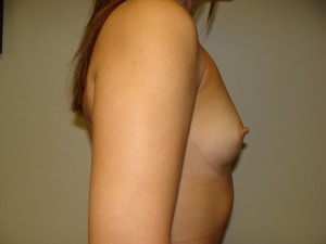Breast Augmentation Before and After 288 | Grover Aesthetics