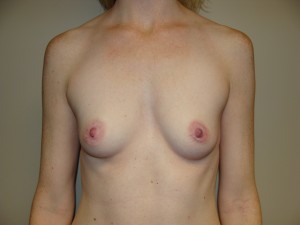 Breast Augmentation Before and After | Grover Aesthetics