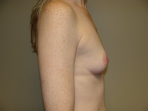 Breast Augmentation Before and After 289 | Sanjay Grover MD FACS