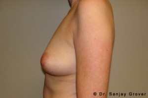 Breast Augmentation Before and After 289 | Sanjay Grover MD FACS