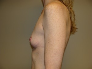 Breast Augmentation Before and After 289 | Sanjay Grover MD FACS