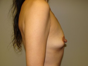 Breast Augmentation Before and After 290 | Grover Aesthetics