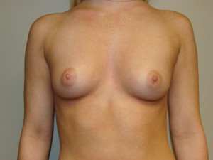 Breast Augmentation Before and After | Grover Aesthetics
