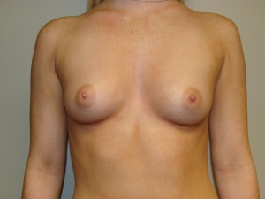 Breast Augmentation Before and After | Sanjay Grover MD FACS