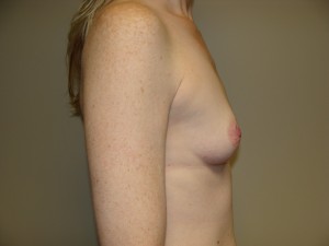Breast Augmentation Before and After 291 | Grover Aesthetics