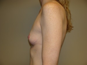 Breast Augmentation Before and After 291 | Grover Aesthetics