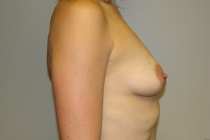 Breast Augmentation Before and After 292 | Grover Aesthetics