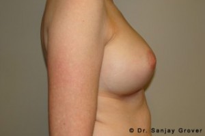 Breast Augmentation Before and After 293 | Sanjay Grover MD FACS