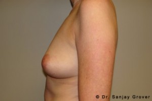 Breast Augmentation Before and After 293 | Sanjay Grover MD FACS