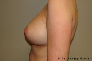 Breast Augmentation Before and After 293 | Sanjay Grover MD FACS