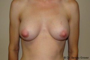 Breast Augmentation Before and After | Grover Aesthetics