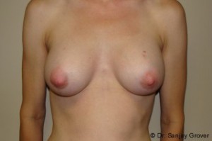 Breast Augmentation Before and After 295 | Sanjay Grover MD FACS