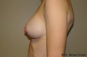 Breast Augmentation Before and After 295 | Grover Aesthetics