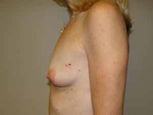 Breast Augmentation Before and After 297 | Grover Aesthetics