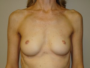 Breast Augmentation Before and After 42 | Sanjay Grover MD FACS