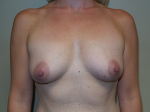 Breast Augmentation Before and After | Grover Aesthetics