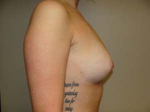 Breast Augmentation Before and After 300 | Grover Aesthetics