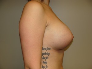 Breast Augmentation Before and After 300 | Grover Aesthetics