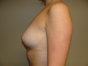 Breast Augmentation Before and After 300 | Grover Aesthetics