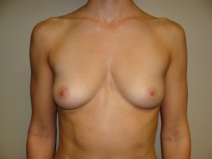 Breast Augmentation Before and After 53 | Sanjay Grover MD FACS