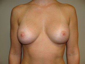 Breast Augmentation Before and After | Grover Aesthetics