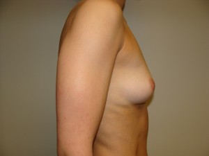 Breast Augmentation Before and After 303 | Grover Aesthetics