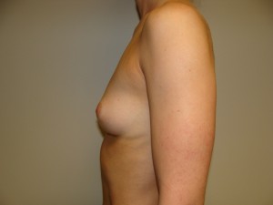 Breast Augmentation Before and After 303 | Grover Aesthetics