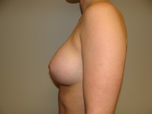 Breast Augmentation Before and After 303 | Grover Aesthetics