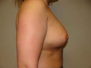 Breast Augmentation Before and After 304 | Grover Aesthetics