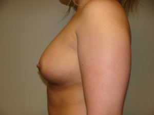 Breast Augmentation Before and After 304 | Grover Aesthetics