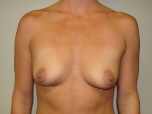 Breast Augmentation Before and After | Grover Aesthetics