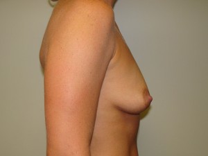 Breast Augmentation Before and After 305 | Grover Aesthetics