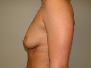 Breast Augmentation Before and After 305 | Grover Aesthetics