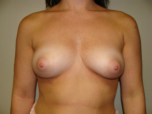 Breast Augmentation Before and After | Grover Aesthetics