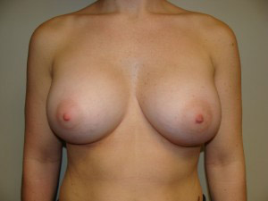 Breast Augmentation Before and After | Grover Aesthetics