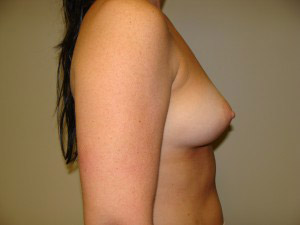 Breast Augmentation Before and After 306 | Grover Aesthetics