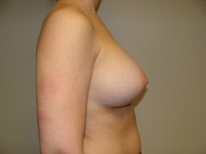 Breast Augmentation Before and After 306 | Grover Aesthetics