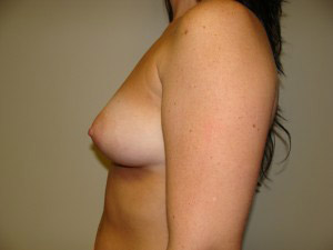 Breast Augmentation Before and After 306 | Grover Aesthetics